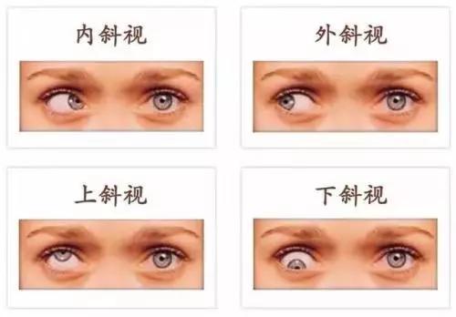 弱视的孩子一定要尽早治疗,千万不能错过最佳时机