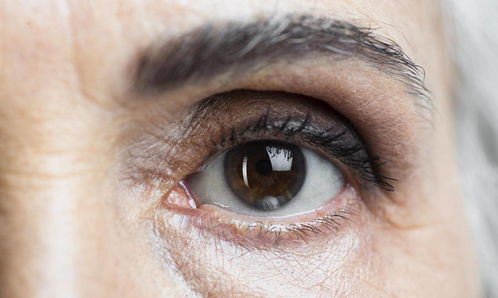胆固醇高不高,通过眼睛或可看出眉目,仔细看看是否有这3个现象