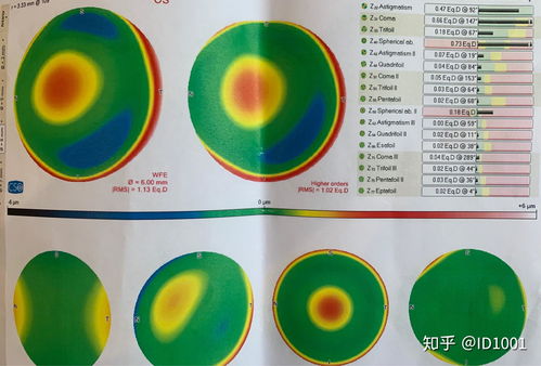 做近视手术后后悔吗