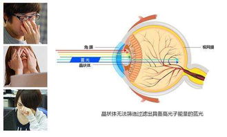 近视激光矫正术后如何防控蓝光电子产品对眼睛的刺激与弱视风险